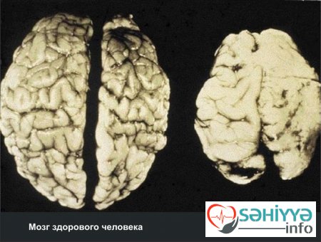 Məşhur professorlar alkoqolun beyinə inanılmaz təsirlərini açıqladı
