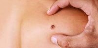 Həkim-dermatonevroloq: Melanoma daha çox qadınlarda rast gəlinir