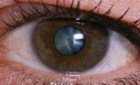 İki min yaşı olan göz xəstəliyi - katarakta
