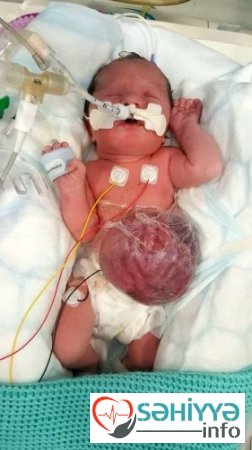 Mədəsi və ciyəri çöldə doğulan qız - 2 yaşı var (FOTO)