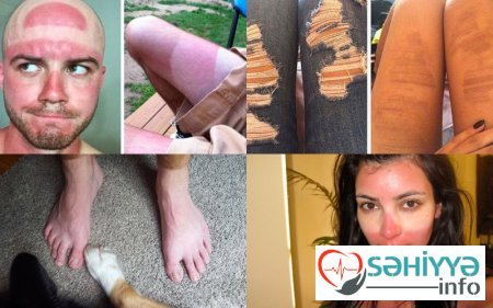 Gülməli günəş yanıqları - Fotolar