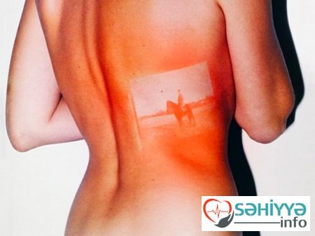 Gülməli günəş yanıqları - Fotolar Gülməli günəş yanıqları - Fotolar