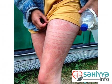 Gülməli günəş yanıqları - Fotolar Gülməli günəş yanıqları - Fotolar