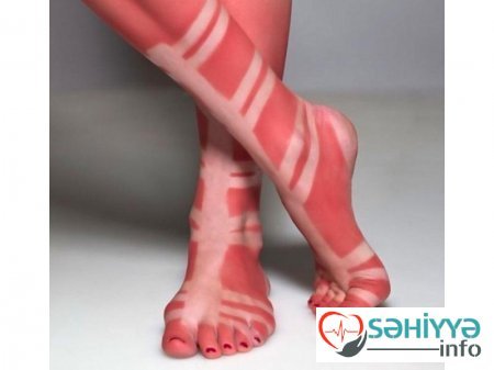 Gülməli günəş yanıqları - Fotolar Gülməli günəş yanıqları - Fotolar