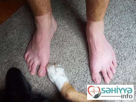 Gülməli günəş yanıqları - Fotolar Gülməli günəş yanıqları - Fotolar