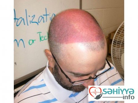 Gülməli günəş yanıqları - Fotolar Gülməli günəş yanıqları - Fotolar