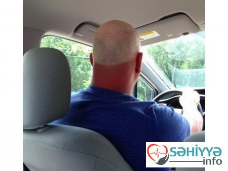 Gülməli günəş yanıqları - Fotolar Gülməli günəş yanıqları - Fotolar