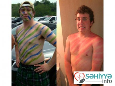 Gülməli günəş yanıqları - Fotolar Gülməli günəş yanıqları - Fotolar