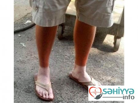 Gülməli günəş yanıqları - Fotolar Gülməli günəş yanıqları - Fotolar