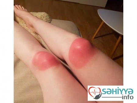 Gülməli günəş yanıqları - Fotolar Gülməli günəş yanıqları - Fotolar