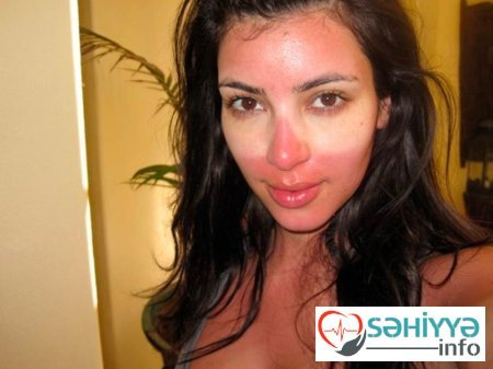 Gülməli günəş yanıqları - Fotolar Gülməli günəş yanıqları - Fotolar