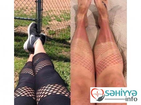 Gülməli günəş yanıqları - Fotolar Gülməli günəş yanıqları - Fotolar