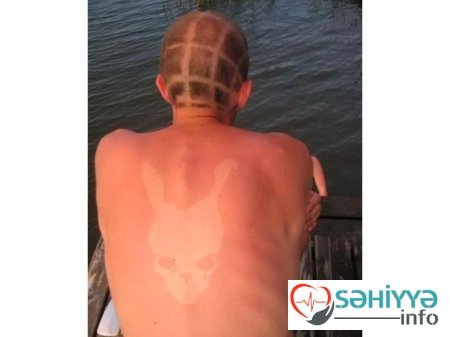 Gülməli günəş yanıqları - Fotolar Gülməli günəş yanıqları - Fotolar