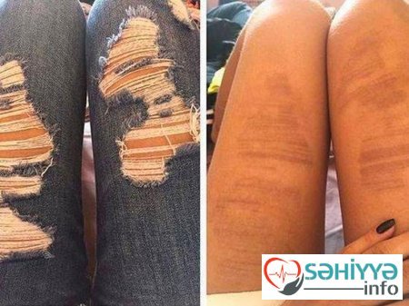 Gülməli günəş yanıqları - Fotolar Gülməli günəş yanıqları - Fotolar