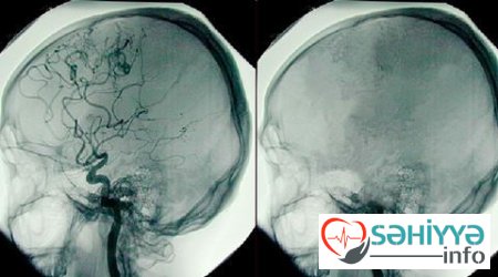 Çinlinin beynindən 13 santimetrlik qurd çıxarıldı – 17 il beynin içində yaşayıb - FOTO