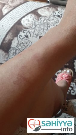 Bakıda "AK Qadın salonu" jurnalistin qollarını yandırdı-FOTO Bakıda "AK Qadın salonu" jurnalistin qollarını yandırdı-FOTO