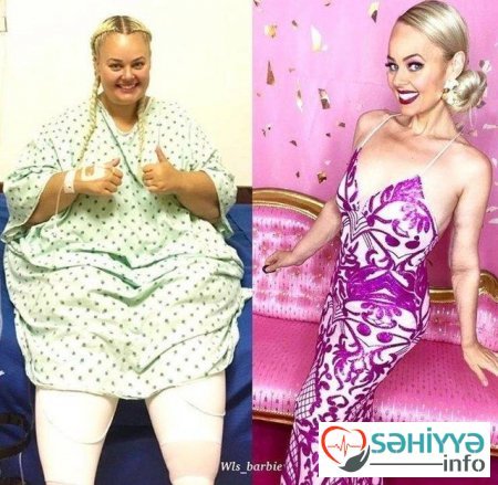 Barbiyə bənzəmək üçün 90 kq arıqladı – FOTOLAR