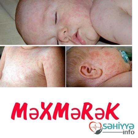 Uşağın bədənindəki səpkilərə görə xəstəliyini tanı - Pediatrdan açıqlama