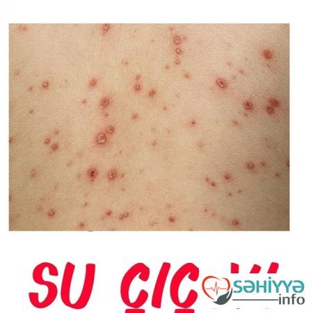 Uşağın bədənindəki səpkilərə görə xəstəliyini tanı - Pediatrdan açıqlama