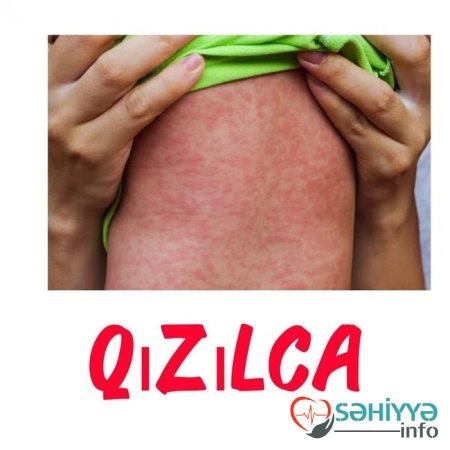 Uşağın bədənindəki səpkilərə görə xəstəliyini tanı - Pediatrdan açıqlama