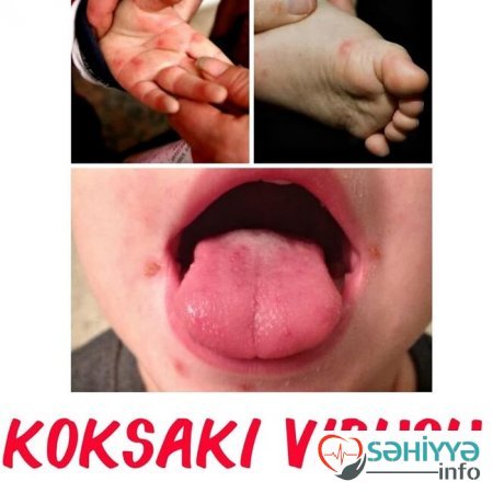 Uşağın bədənindəki səpkilərə görə xəstəliyini tanı - Pediatrdan açıqlama