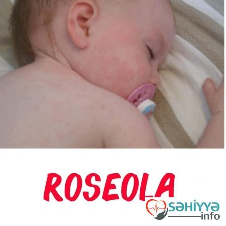 Uşağın bədənindəki səpkilərə görə xəstəliyini tanı - Pediatrdan açıqlama