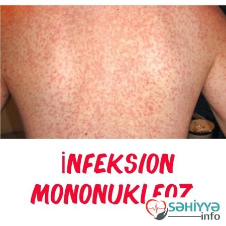 Uşağın bədənindəki səpkilərə görə xəstəliyini tanı - Pediatrdan açıqlama