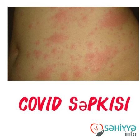 Uşağın bədənindəki səpkilərə görə xəstəliyini tanı - Pediatrdan açıqlama