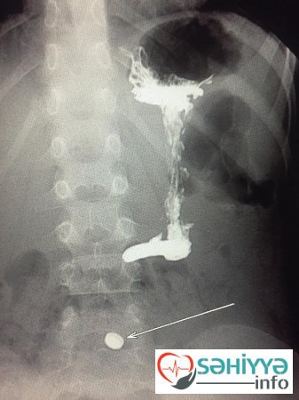 Bakıda azyaşlının qarnından çıxan HAMINI HEYRƏTƏ SALDI Bakıda azyaşlının qarnından çıxan HAMINI HEYRƏTƏ SALDI