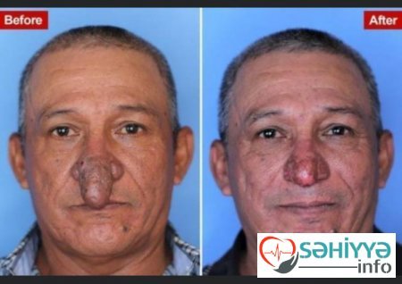 Burnu ağzına girdiyinə görə əməliyyat olundu - FOTO