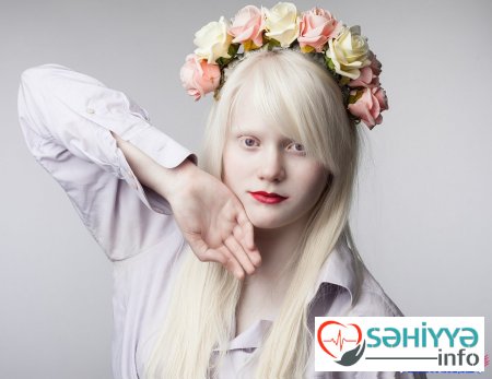 Albinos Albinizm nədir