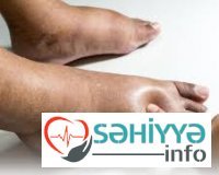 Limfostaz və onun müalicə metodları.Həkim məsləhəti