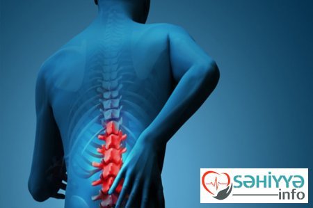 Bel yırtığı kimlərdə daha çox rast gəlinir? - CAVAB