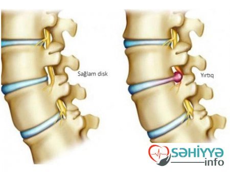 Bel yırtığına daha çox kimlərdə rast gəlinir? – CAVAB