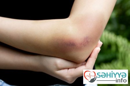 Həkimlər bədəndəki müəmmalı göyərmələrin sirrini tapıblar