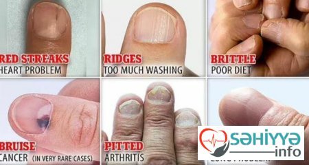Dırnaqlarınız sağlamlığınız haqqında nə deyir?