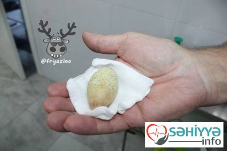 Qızıl qiymətinə öd daşları - Azərbaycanda dananın öd daşı 100 manatdır? - Araşdırma