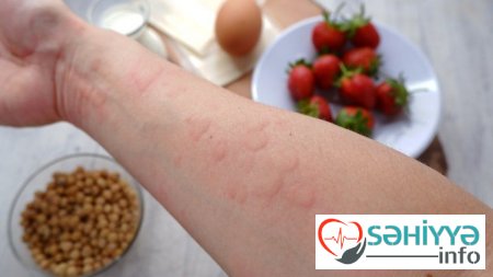 Böyüklərdə allergiya: dərman və qida allergiyasının - ƏLAMƏTLƏRİ