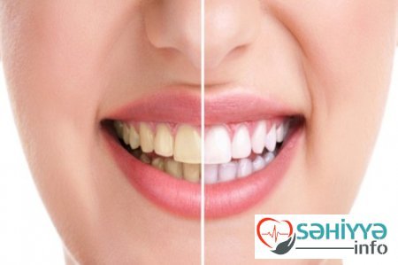 Diş sarılığından necə xilas olmaq olar? - STOMATOLOQ AÇIQLADI