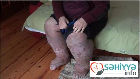 Türkiyədə mühafizəçini ağcaqanad dişlədi: Həyatını xilas etmək mümkün olmadı -FOTO