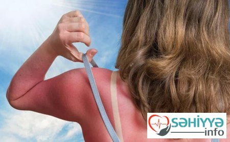 Günəş yanmasını necə sağaltmaq olar?