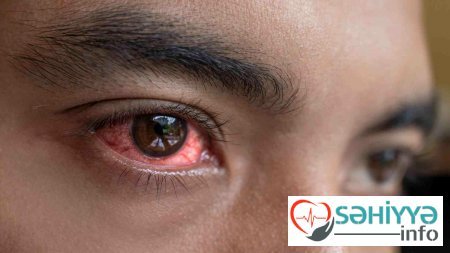 Gözlərin sulanması bu xəstəlikdən xəbər verir22