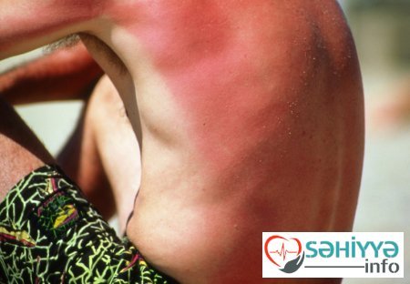 İstidən zəifləmə və halsızlıq hallarının qarşısını necə alaq ? Həkim məsləhəti