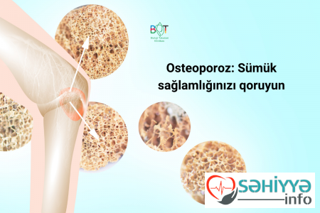 Osteoporoz: Sümük sağlamlığınızı qoruyun