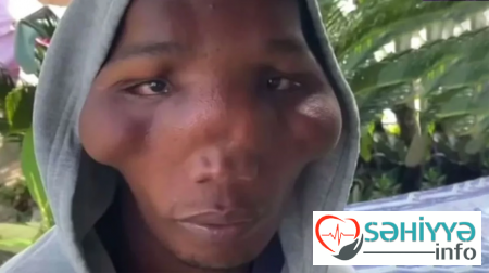 Bu ailənin xəstəliyinin çarəsi tapılmır - üçbucaq baş... - FOTOlar