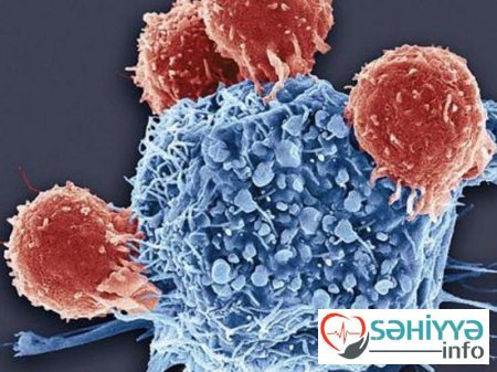 Sistit hansı halda xərçəngin əlaməti ola bilər?