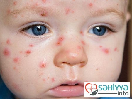 Bu ölkədə qızılca epidemiyası elan edildi