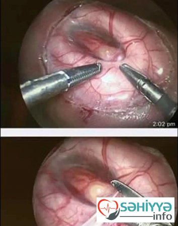Körpə ana bətnində onurğa beynindən əməliyyat olundu - indi qızcığaz nəinki hərəkət edir, həm də qaça bilir...