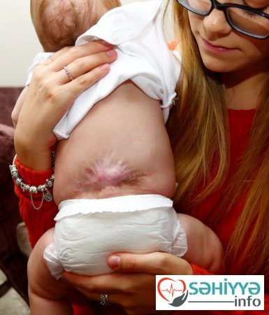 Körpə ana bətnində onurğa beynindən əməliyyat olundu - indi qızcığaz nəinki hərəkət edir, həm də qaça bilir...