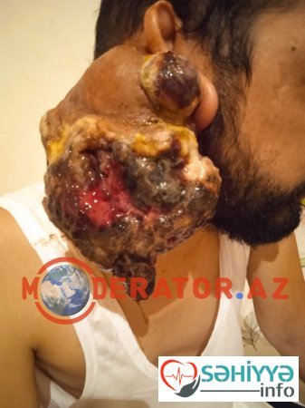 "Sabunçu" xəstəxanasında əməliyyat olunan xəstə: "Həkim məndən heç bir analiz götürmədən əməliyyat etdi" "Sabunçu" xəstəxanasında əməliyyat olunan xəstə: "Həkim məndən heç bir analiz götürmədən əməliyyat etdi"